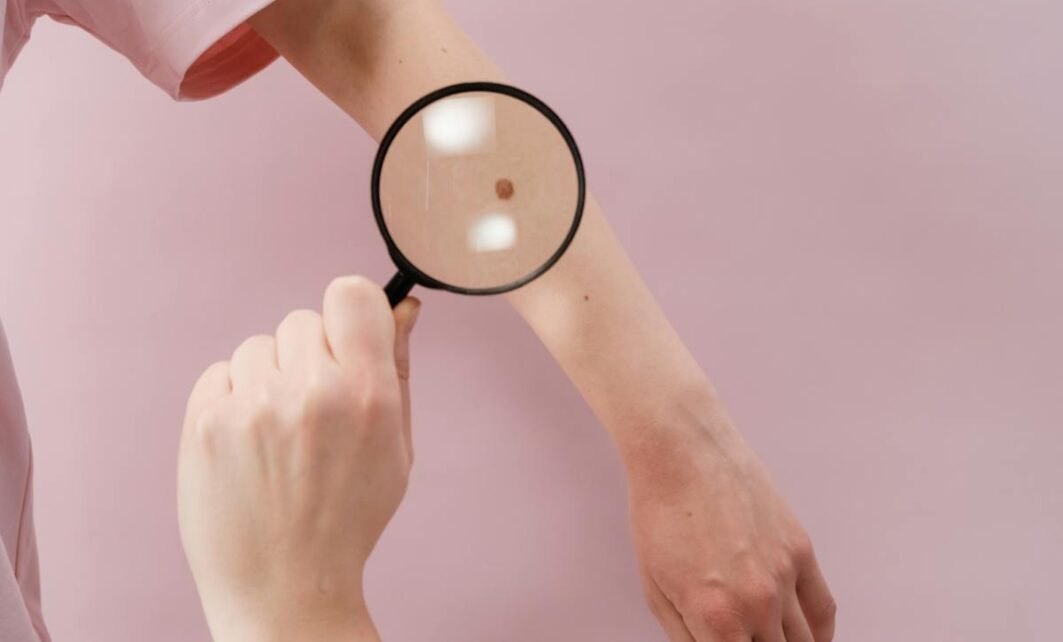 Prevenzione Cutanea: Quando Nei Sospetti Devono Preoccupare